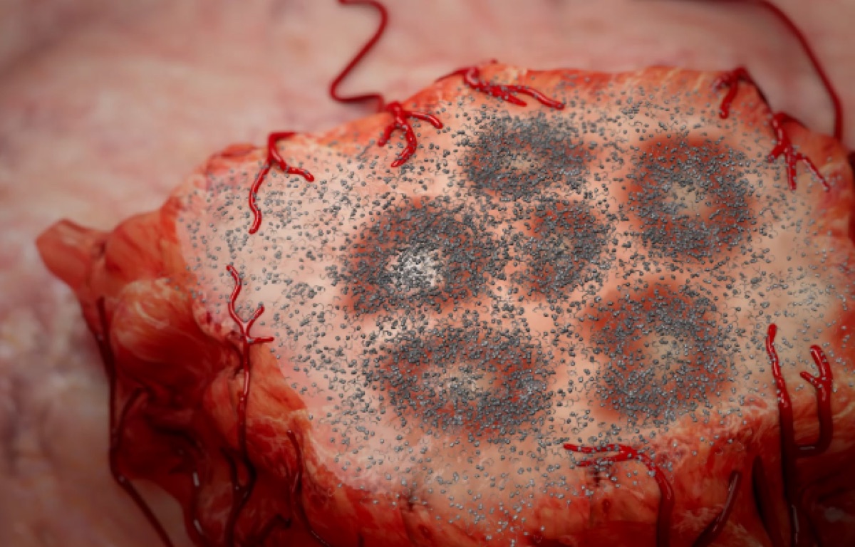 Bacterial Drones distributed throughout tumor volume reaching low-oxygen regions
