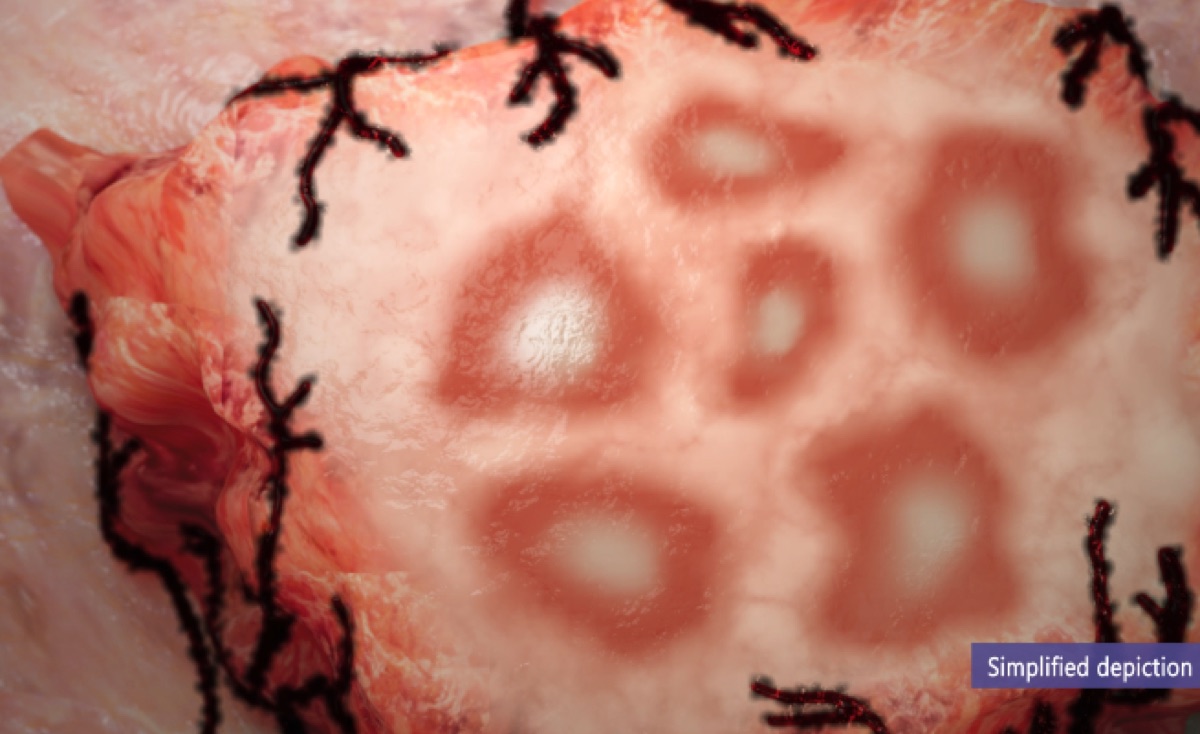 Tumor cross-section illustrating poor blood-vessel perfusion